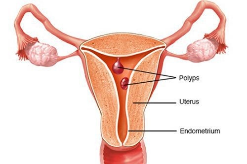 polyp tử cung