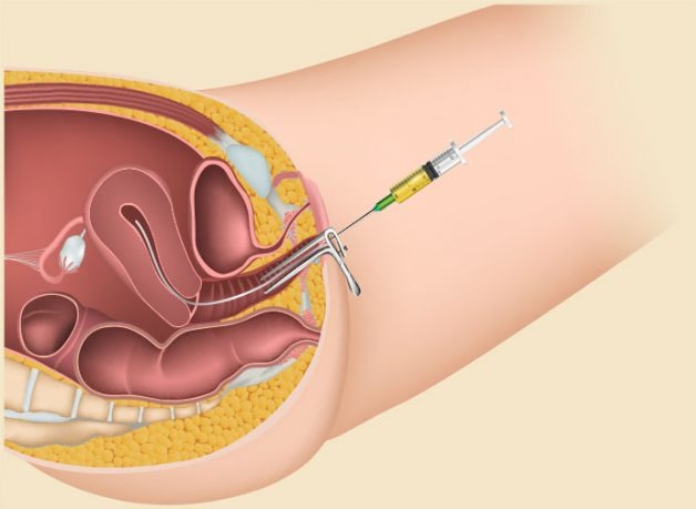 Uống thuốc tránh thai bị trễ kinh, bơm IUI 2 lần không đậu 