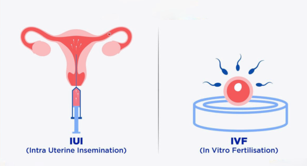 IUI và IVF