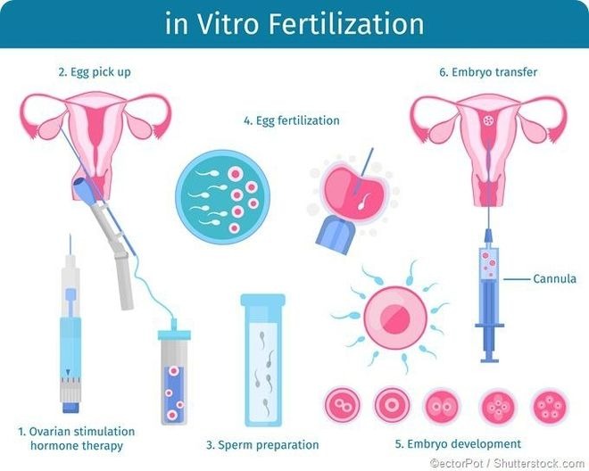 IVF