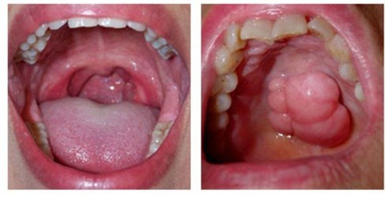 xét nghiệm HPV