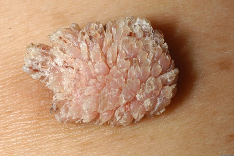 nốt sùi