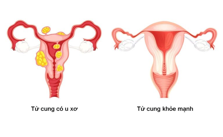 U xơ tử cung