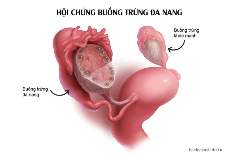 buồng trứng đa nang