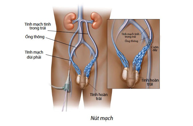 giãn tĩnh mạch