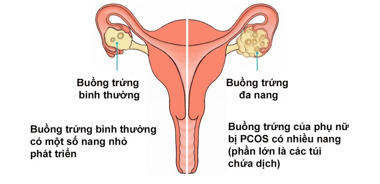 buồng trứng đa nang