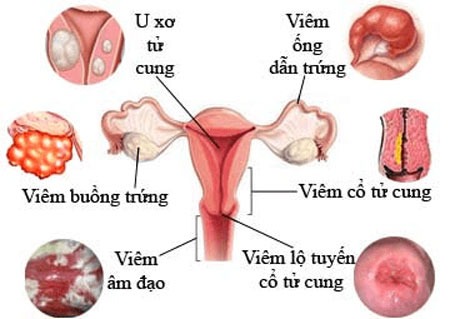 viêm phụ khoa