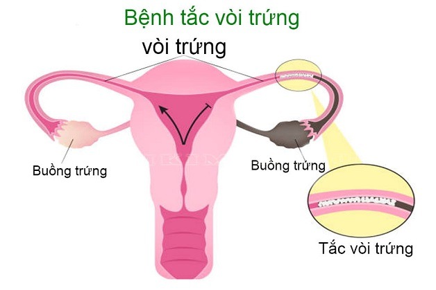 tắc vòi trứng