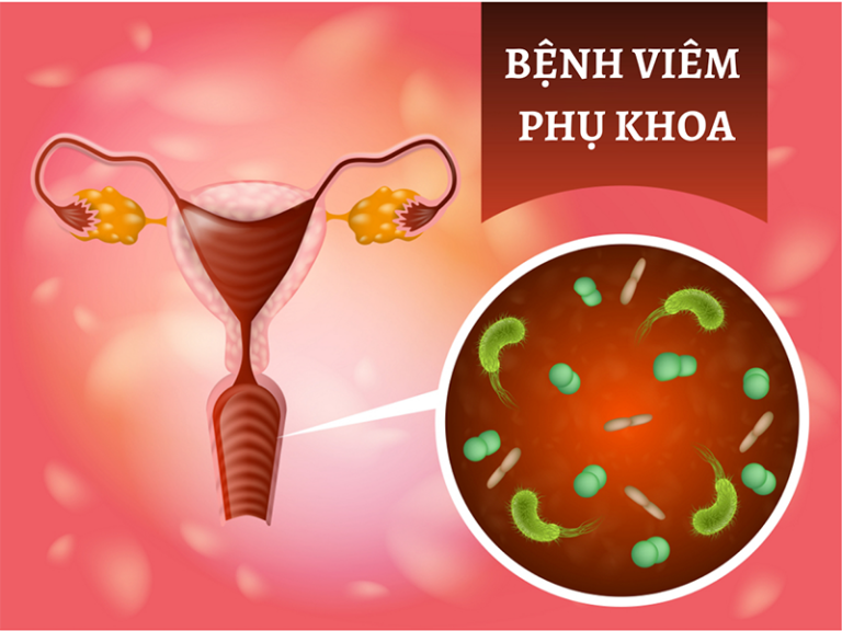 viêm phụ khoa