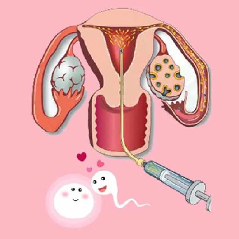 IUI