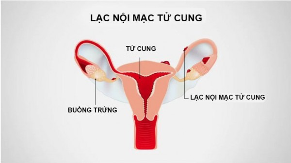 lạc nội mạc tử cung