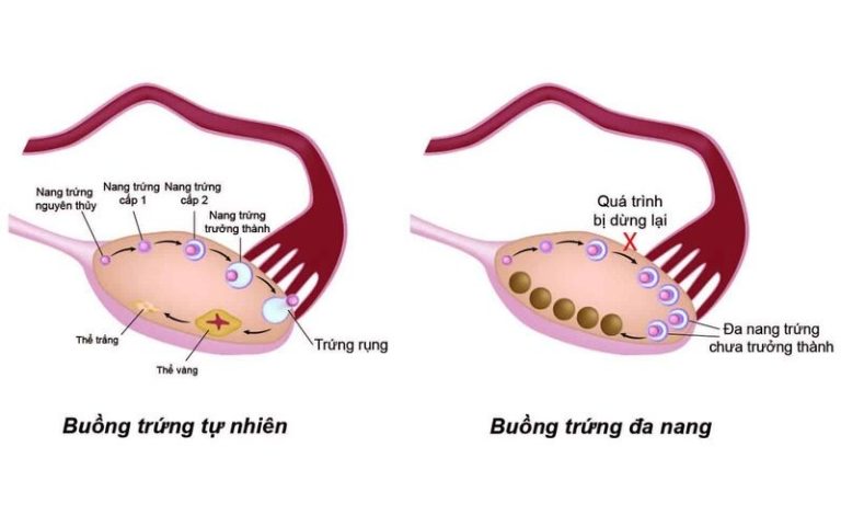 đa nang buồng trứng