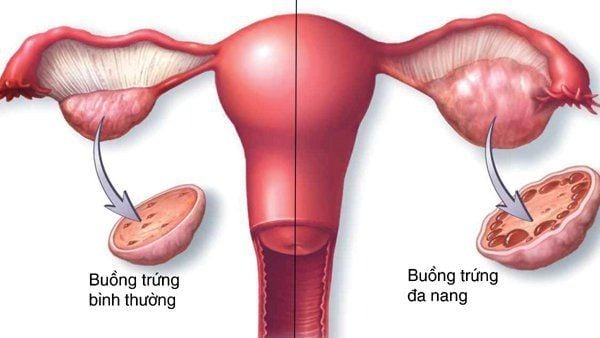 đa nang buồng trứng