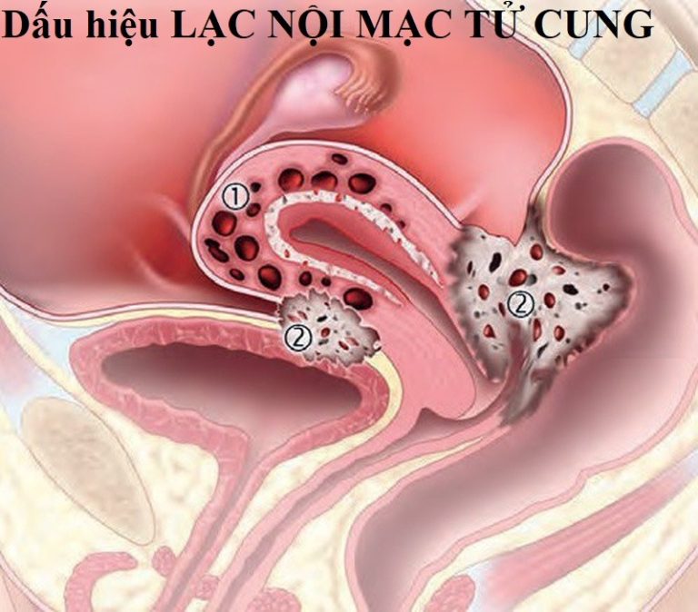 lạc nội mạc tử cung