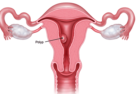 polyp tử cung