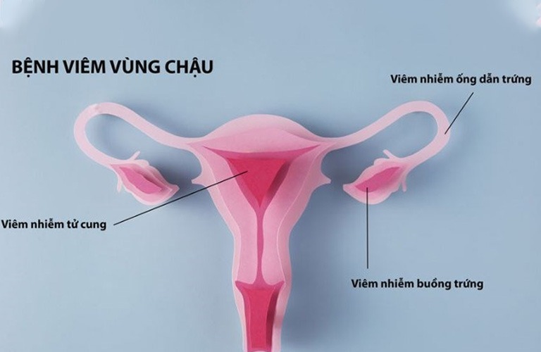 viêm vùng chậu