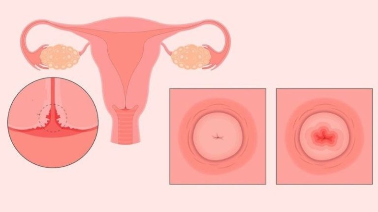 điều trị viêm lộ tuyến
