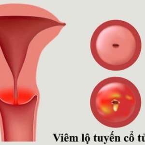 điều trị viêm lộ tuyến
