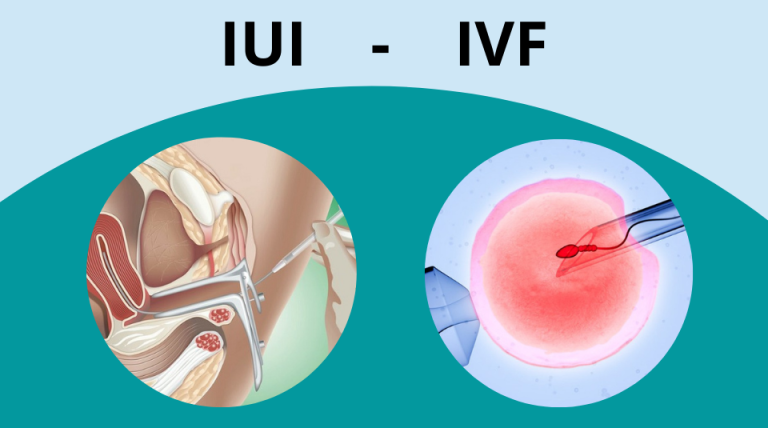 IUI
