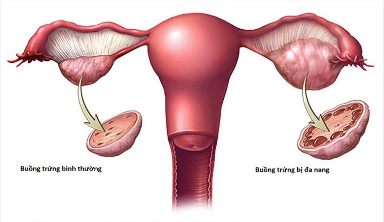 buồng trứng đa nang