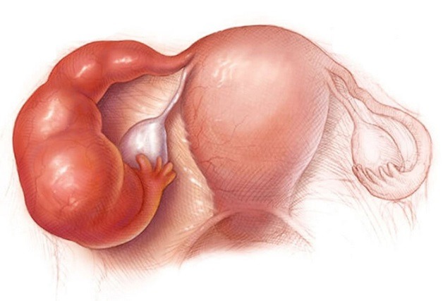 IVF