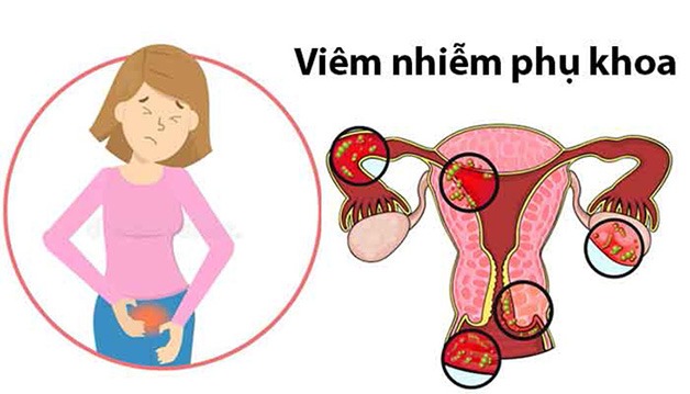 điều trị viêm phụ khoa
