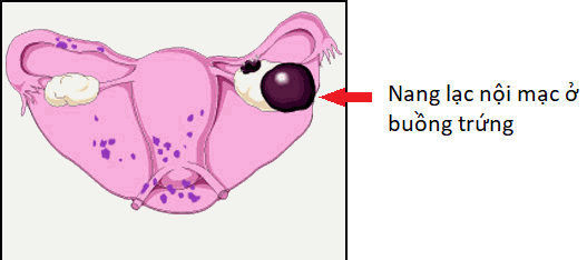 u lạc nội mạc ở buồng trứng