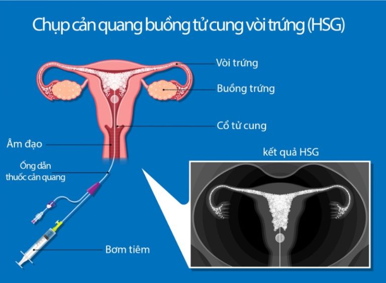 IUI