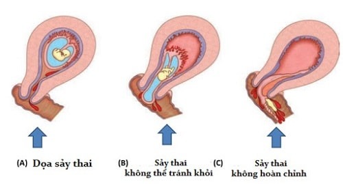 sảy thai