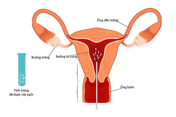 IUI