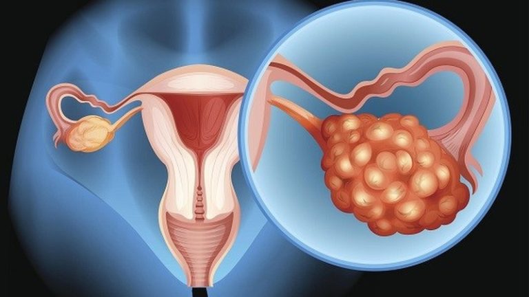 IVF