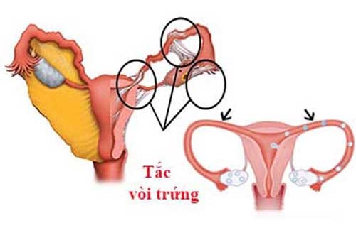 tắc vòi trứng