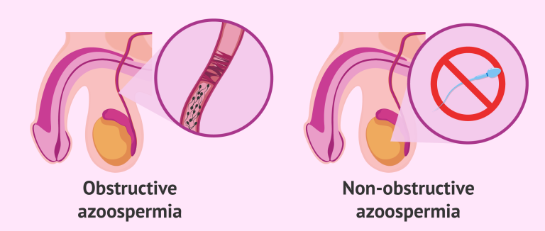azoospermia