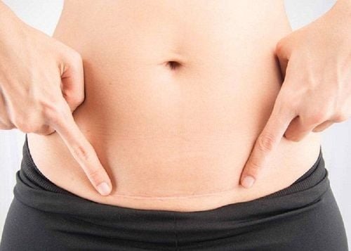 khâu phục hồi sẹo mổ cũ