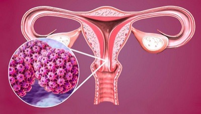 dương tính hpv nhóm nguy cơ cao