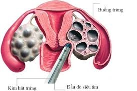 hút trứng