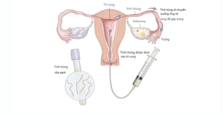IUI