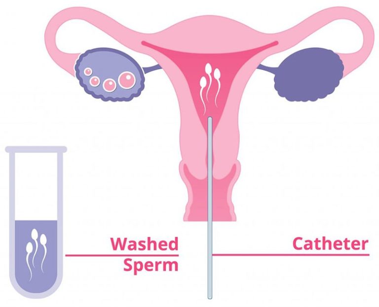 IUI