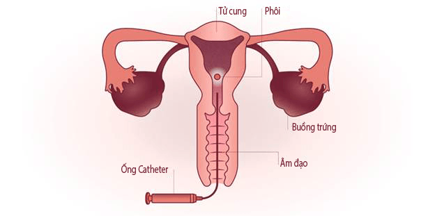 chuyển 2 phôi