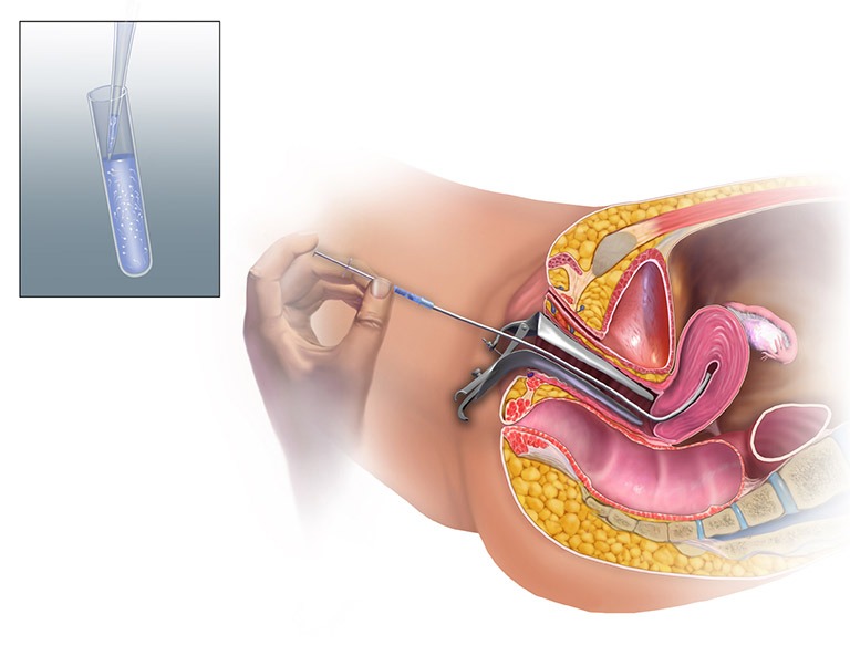 IUI