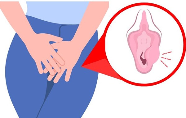 viêm tuyến bartholin
