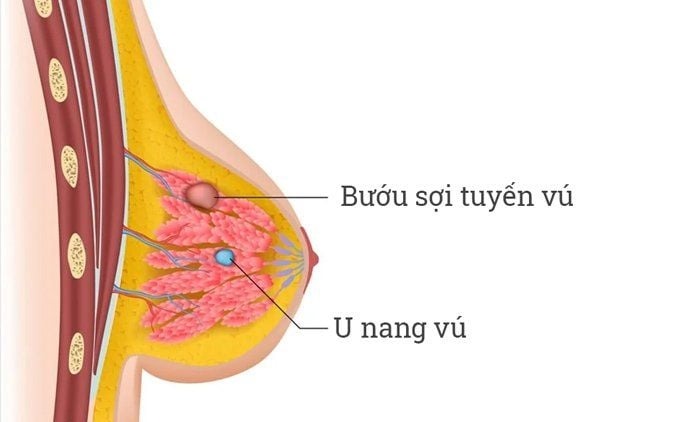 đa bướu sợi tuyến vú