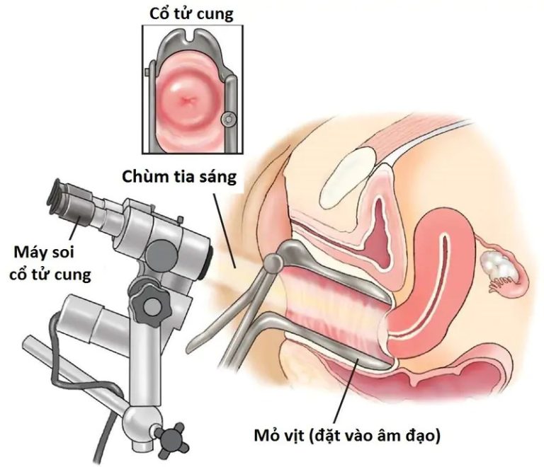 cổ tử cung