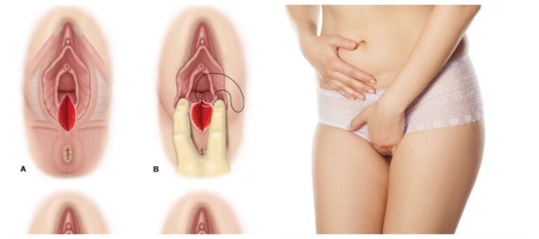 vết rạch tầng sinh môn