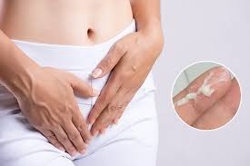 khí hư ra nhiều