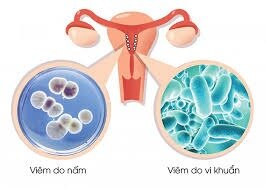 viêm âm đạo