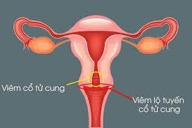 viêm cổ tử cung