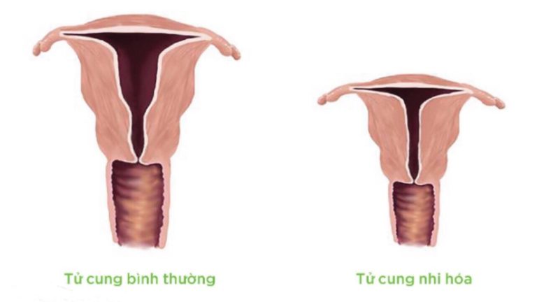 tử cung nhi hóa