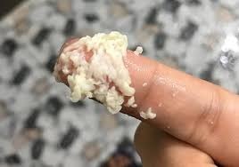 khí hư bã đậu