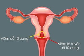 viêm lộ tuyến
